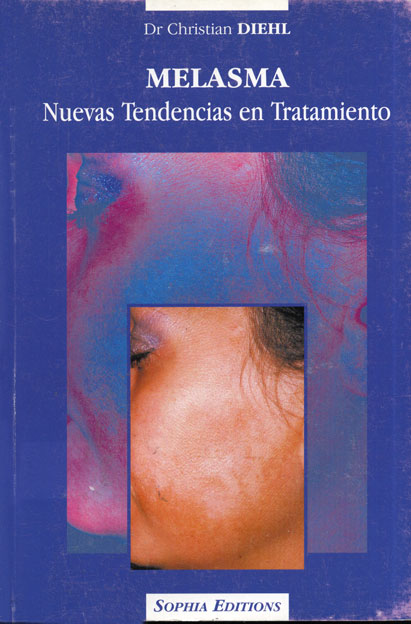 Melasma nuevas tendencias en tratamiento