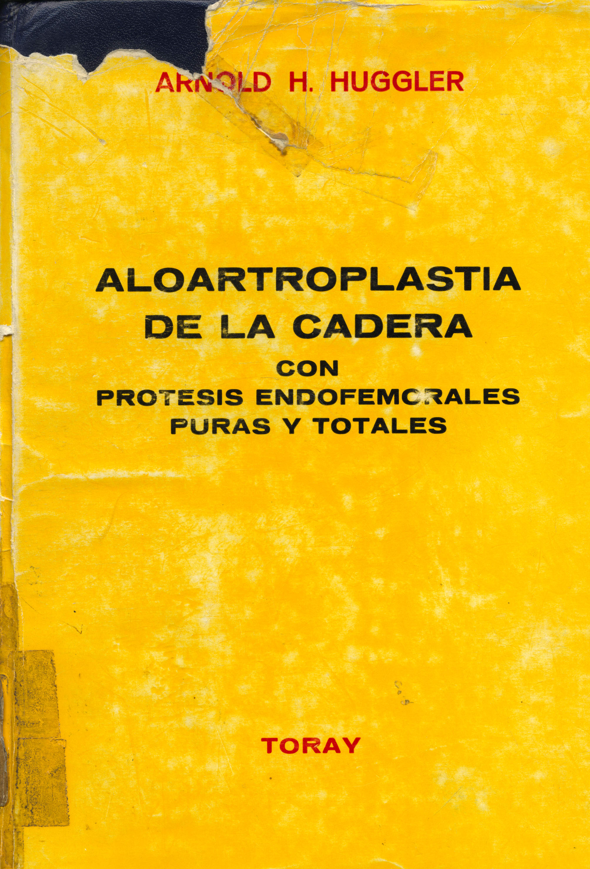 Aloartroplastia de la cadera con protesis endofemorales puras y totales