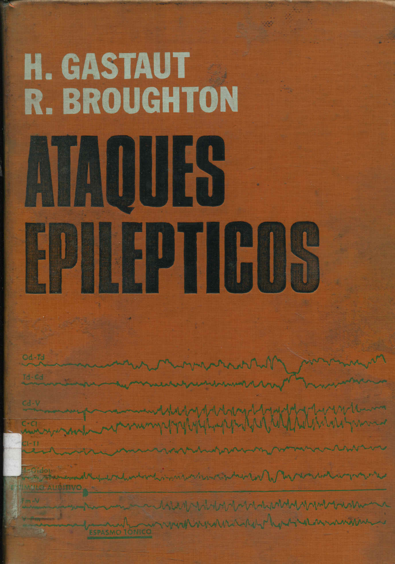 Ataques Epilepticos: Clinica, Electroencefalografia, Diagnostico y Tratamiento