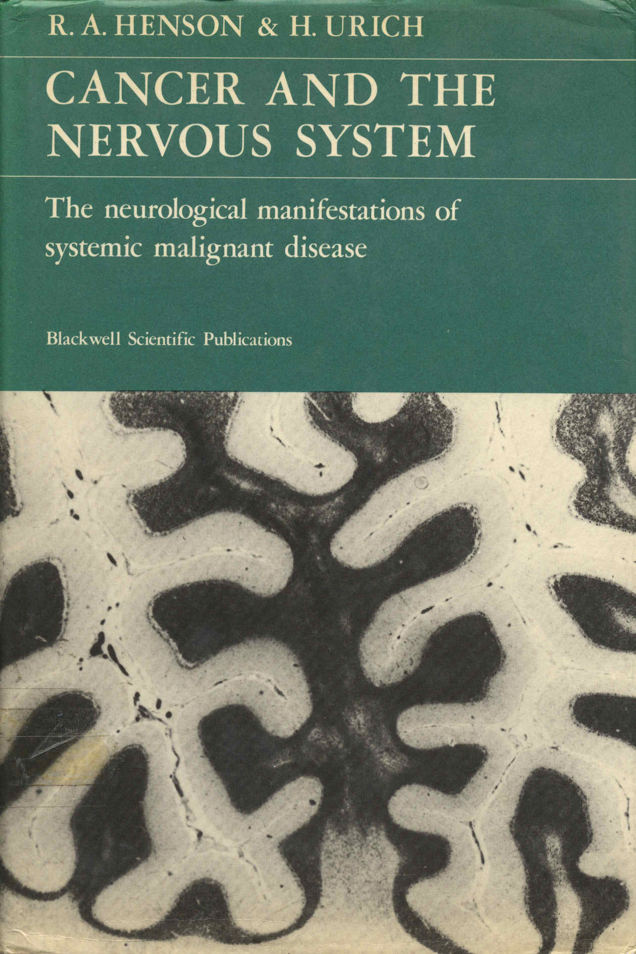 Cancer and the nervous system the neuroligical manifestations of systemic malignant disease