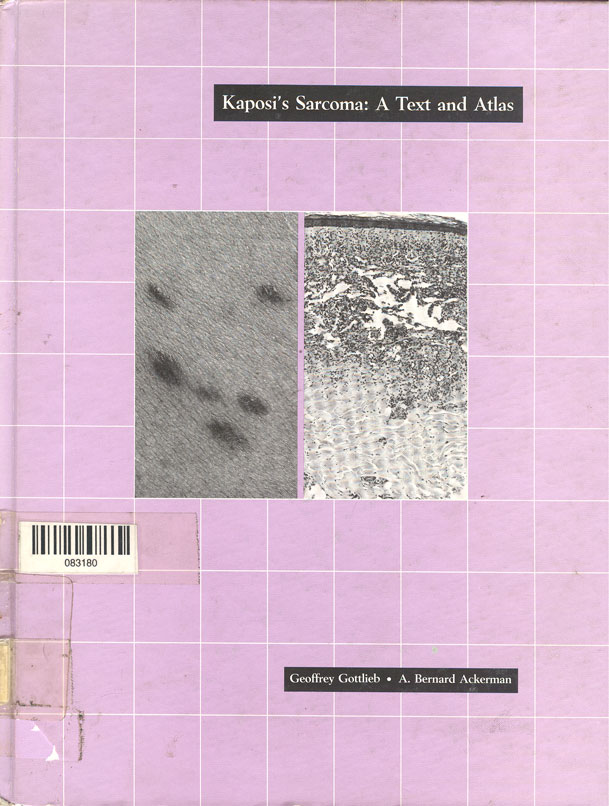 Kaposi's sarcoma