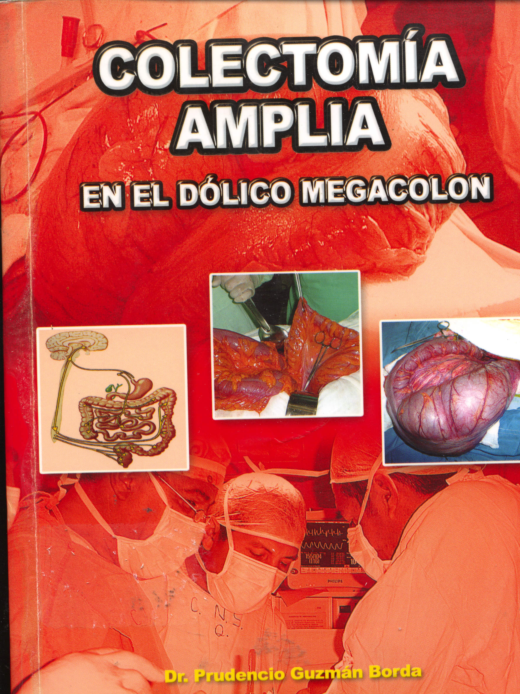 Colectomia amplia: En el dólico megacolon