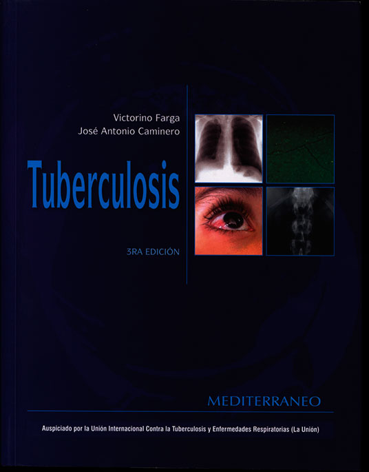 Tuberculosis