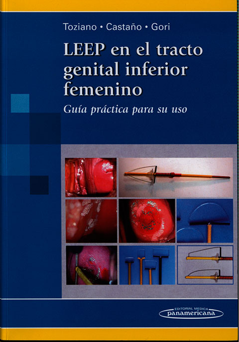 LEEP en el tracto genital inferior femenino: guia practica para su uso
      <i>es</i>