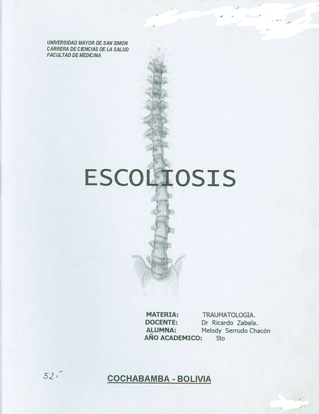 Escoliosis