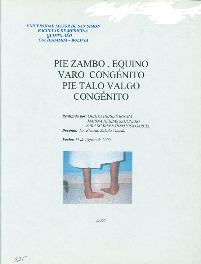 Pie Zambo, Equino Varo CongÚnito Pie Talo Valgo CongÚnito